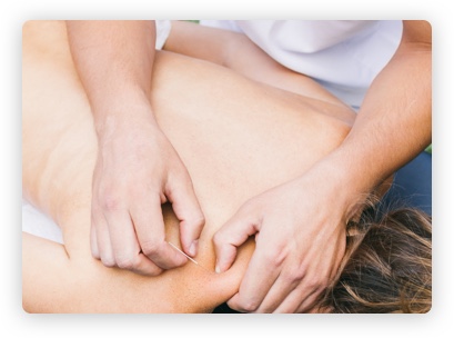 Needling - Physiotherapy in Port Macquarie, NSW